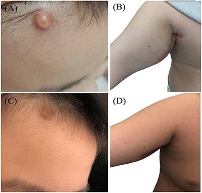 Clinical Analysis of Pediatric Systemic Juvenile Xanthogranulomas: A Retrospective Single-Center Study